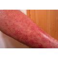 Psoriasis, pikkelysömör és az aloe vera