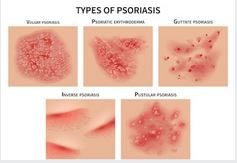 pikkelysömör orvosság spray guttate psoriasis treatment guidelines