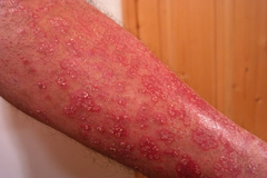 Bőrbetegségek: pikkelysömör, psoriasis, ekcéma kezelése gombákkal