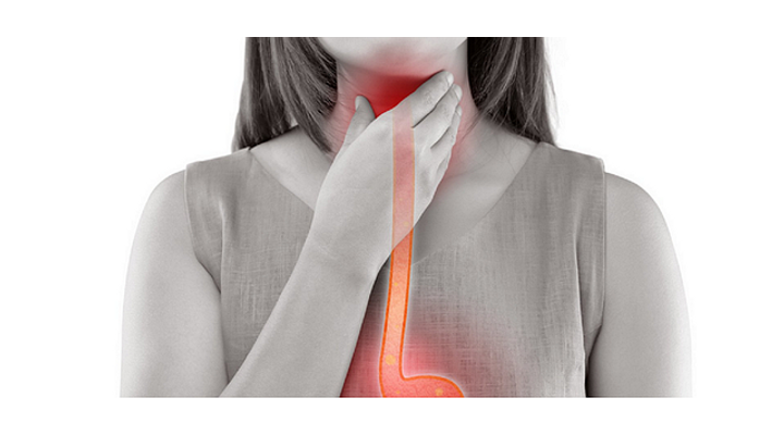 GERD vagy nyelőcső Reflux