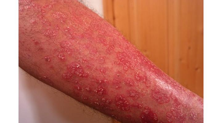 Psoriasis, pikkelysömör és az aloe vera