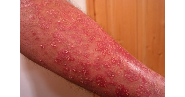 Ez a leggyakoribb krónikus bőrbetegség - HáziPatika